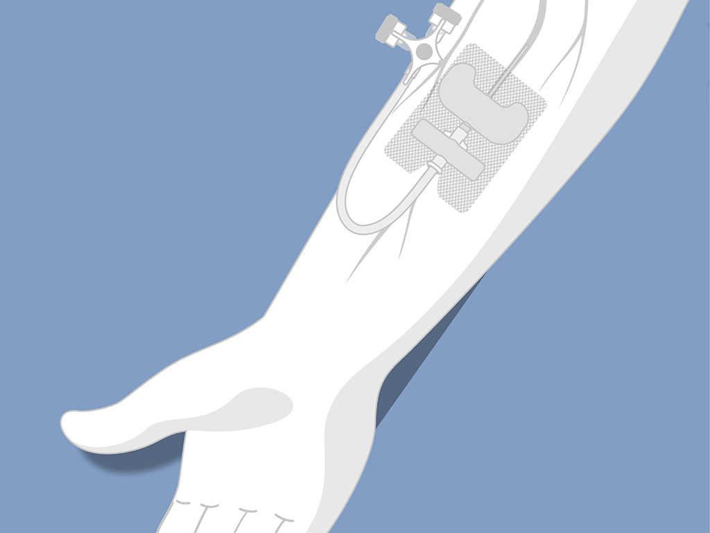 Sets pose cathéter veineux (CVP-CVC)