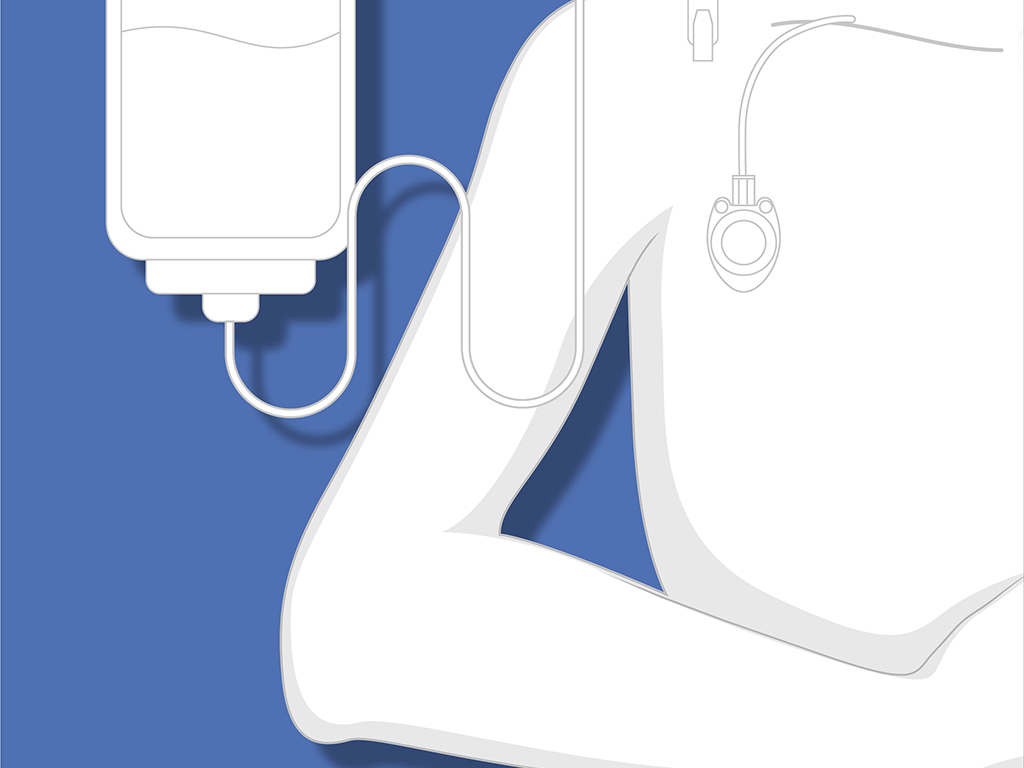 Sets pose cathéter veineux (CVP-CVC) / à Chambre Implantable