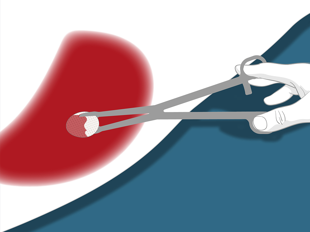 Sets de désinfection | Badigeonnage Pré-Op