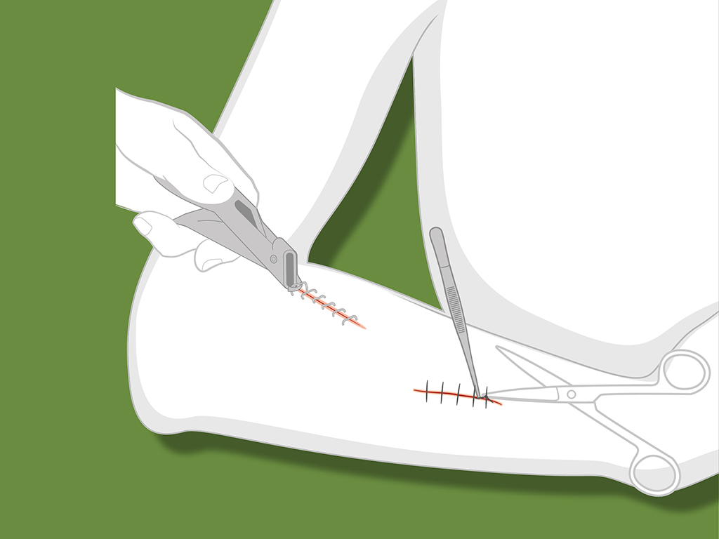 Sets suture / ablation suture, agrafes